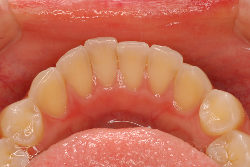 前歯部舌側面観